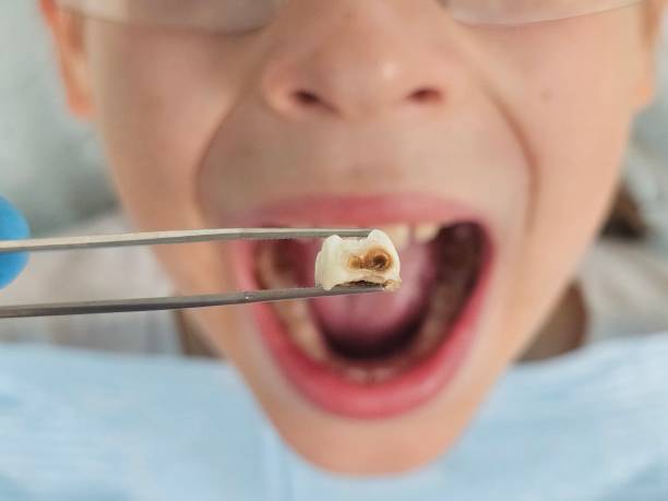 Best Emergency Dental Care for Broken or Chipped Teeth in Diablo Grande, CA